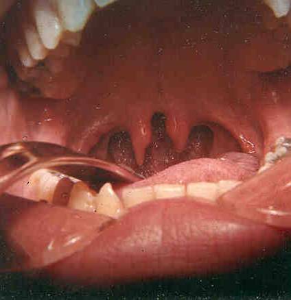 bifid uvula (slight cleft palate)