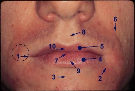 labial commissure (corner of lip)