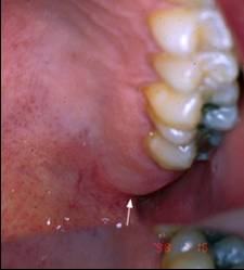 maxillary tuberosity 
