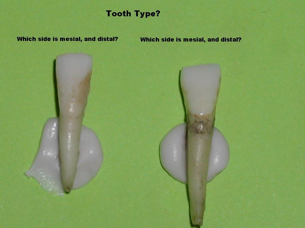 Left =md central (?)     rt=md lateral (rt mesial)